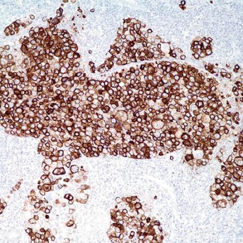 Mesothelioma(HBME-1) Antibody Reagent for Immunohistochemistry